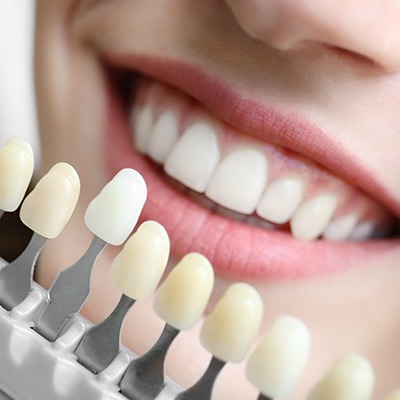 porcelain-veneers-absolute-dentistry-general-and-family-dentist-okotoks-alberta Porcelain Veneers | Absolute Dentistry | Family & General Dentist | Okotoks Dentist
