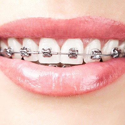 Damon Braces | Absolute Dentistry | Family & General Dentist | Okotoks Dentist